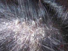 怎么會出現脂溢性脫發的？